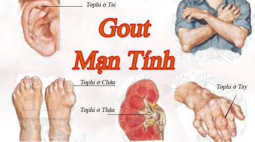 Đẩy lùi bệnh Gout (Gút) theo đông y an toàn