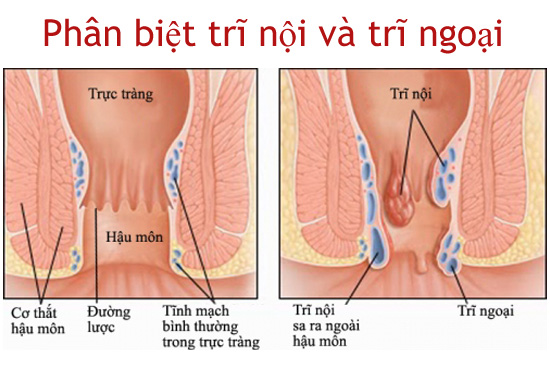 DẤU HIỆU NHẬN BIẾT BỆNH TRĨ ĐƠN GIẢN TẠI NHÀ