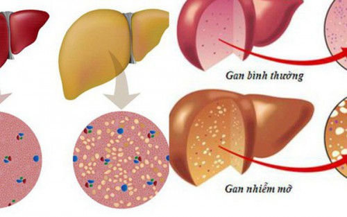 Đẩy lùi xơ gan, gan nhiễm mỡ nhờ Đông y