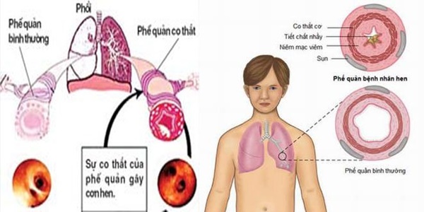 Loại Bỏ Hen Suyễn Hen Phế Quản Bằng Phương Pháp Đông Y