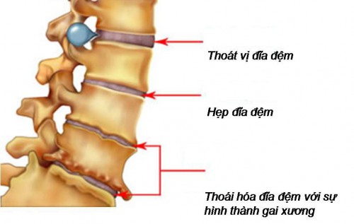 Thoái hóa cột sống và phương pháp đẩy lùi