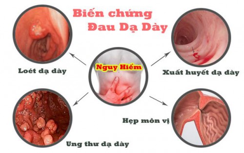 Giảm triệu chứng viêm loét dạ dày, tá tràng